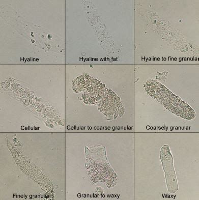 At <strong>urine</strong> S. . High hyaline casts in urine